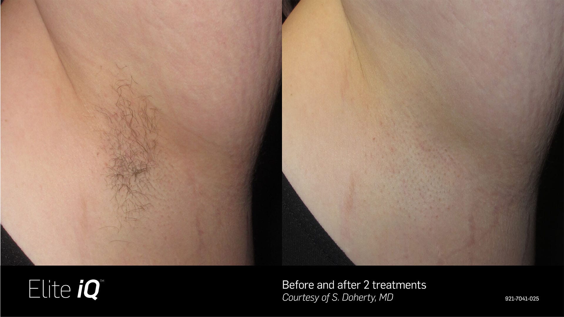 Elite iQ™ Laser Hair Removal