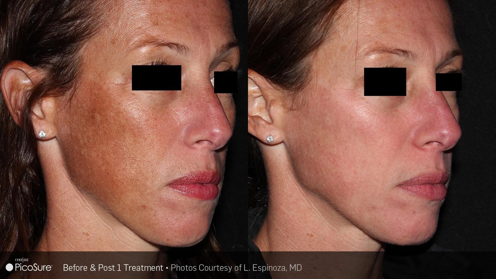 Picosure 1
