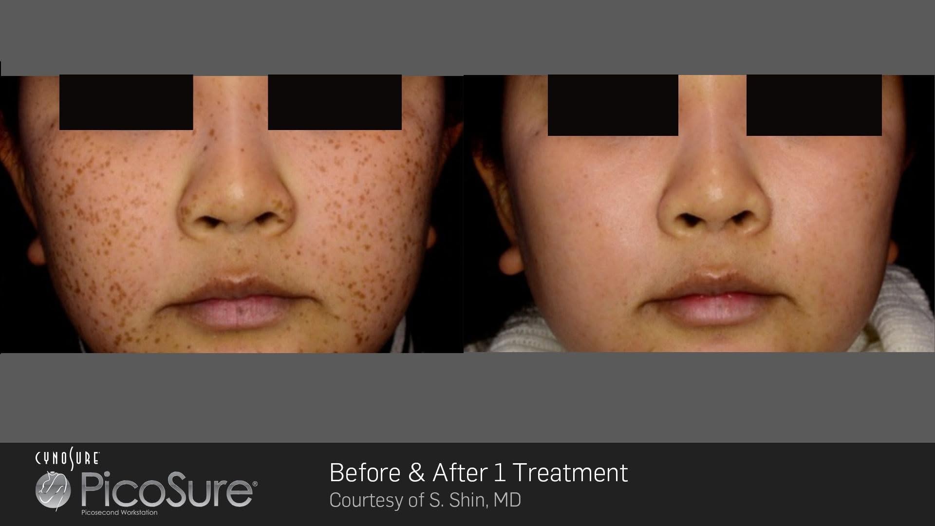 Picosure 2