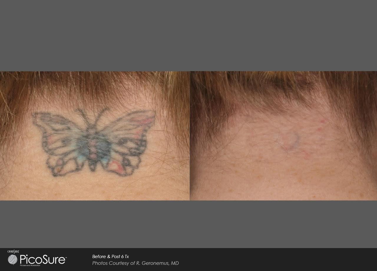 Picosure 3