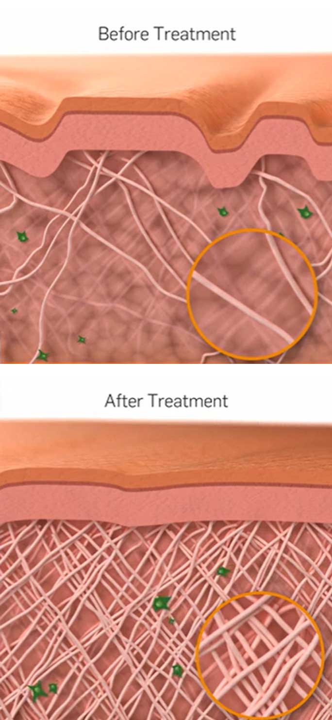TempSure Envi™ 1