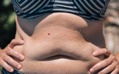Why Fat Comes Back in Uneven Spots After Liposuction (and What the Science Actually Says)
